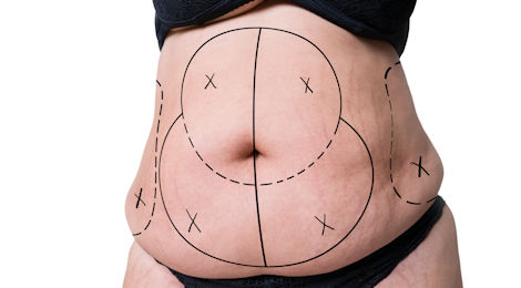 Will Tummy Tuck Scars Go Away, and Does it Remove Fat?