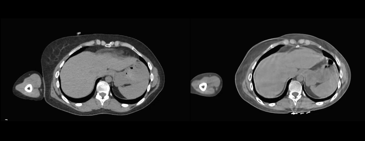 Varian HyperSight image of a pancreas